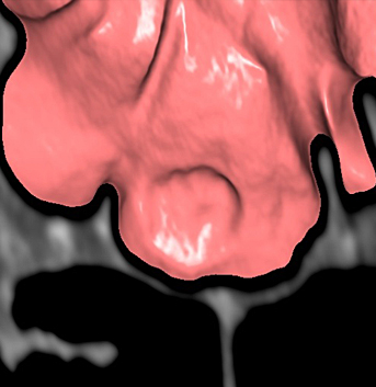 大腸CTで見たポリープの写真