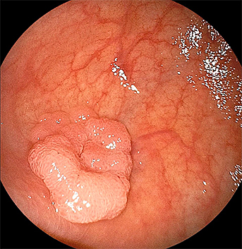 内視鏡で見た同ポリープの写真